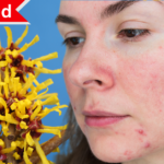 Is Witch Hazel Good for Rosacea?