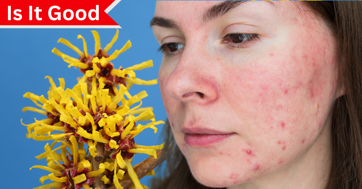 Is Witch Hazel Good for Rosacea?